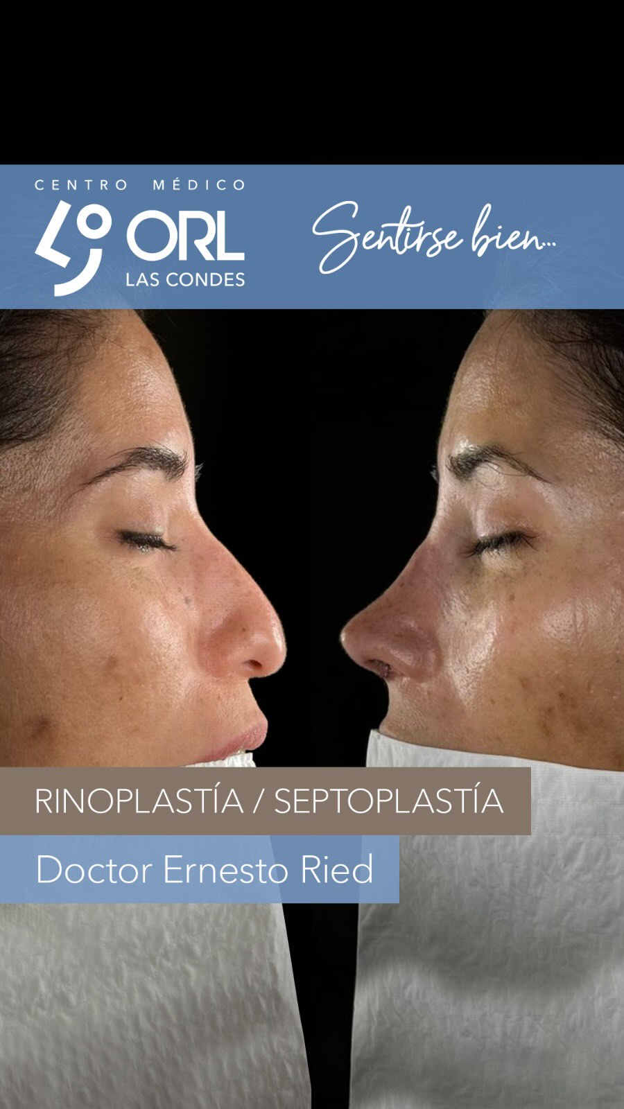 Muy feliz con el resultado inmediato post quirúrgico de esta rinoplastia primaria 🤗
Después de analizar sus exámenes para ver cómo respiraba, fotografíar todos los ángulos para ver los aspectos estéticos y escuchar qué es lo que quería la paciente, llegamos en conjunto, a este resultado en una simulación que es el que buscamos con la cirugía.
ORL Las Condes es ese espacio donde el paciente puede confiar plenamente los cuidados de su salud en las manos de otorrinos expertos. Atendemos y asesoramos a pacientes que valoran la experiencia y que buscan atención personalizada.
📍Centro Médico ORL las Condes en Estoril 200, Oficina 723, Las Condes, Santiago de Chile
Teléfono: +56 2 2480 1700
Whats app: +56 9 8846 5438
Mail: secretaria@orl-lascondes.cl
WEB: www.orl-lascondes.cl
⚠️ Los comentarios ofensivos o discriminatorios serán eliminados/bloqueados para proteger la integridad del paciente.
⚠️ Los resultados de cada paciente son únicos y dependen de sus antecedentes, tipo de piel, cirugía/técnica, cicatrización/recuperación y cuidados postoperatorios.
#rinoplastía #rinoseptoplastía #rinoplastíaultrasonica #rinoplastiaestetica #rhinoplasty #cirugiaestetica #rinoplastiasantiago #rinoplastiafuncional