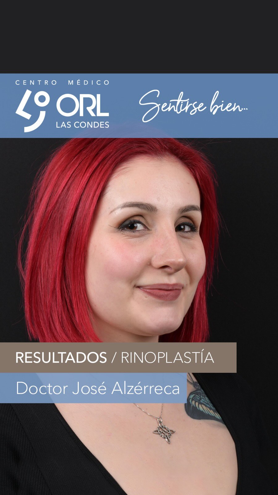 Después de varios meses de post operatorio vemos este super resultado!
Cada caso es distinto y siempre nos tomamos el tiempo de analizar, fotografiar y conversar cada detalle existente.
🍀 ORL Las Condes es ese espacio donde el paciente puede confiar plenamente los cuidados de su salud en las manos de otorrinos expertos. Atendemos y asesoramos a pacientes que valoran la experiencia y que buscan atención personalizada.
📍 Centro Médico ORL las Condes en Estoril 200, Oficina 723, Las Condes, Santiago de Chile
Teléfono: +56 2 2480 1700
Whats app: +56 9 8846 5438
Mail: secretaria@orl-lascondes.cl
WEB: www.orl-lascondes.cl
⚠️ Los comentarios ofensivos o discriminatorios serán eliminados/bloqueados para proteger la integridad del paciente.
⚠️ Los resultados de cada paciente son únicos y dependen de sus antecedentes, tipo de piel, cirugía/técnica, cicatrización/recuperación y cuidados postoperatorios.
#rinoplastía #rinoseptoplastía #rinoplastíaultrasonica #rinoplastiaestetica #rhinoplasty #cirugiaestetica #rinoplastiasantiago #rinoplastíafuncional #reconstrucciónnasal #orl #otorrinolaringología #nariz #antesydespués