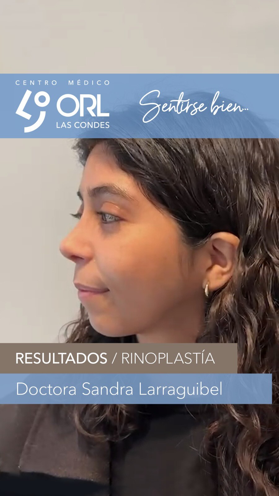4 meses de evolución de su rinoplastia. Felices con su cambio! 🤗
🍀 ORL Las Condes es ese espacio donde el paciente puede confiar plenamente los cuidados de su salud en las manos de otorrinos expertos. Atendemos y asesoramos a pacientes que valoran la experiencia y que buscan atención personalizada.
📍Centro Médico ORL las Condes en Estoril 200, Oficina 723, Las Condes, Santiago de Chile
Teléfono: +56 2 2480 1700
Whats app: +56 9 8846 5438
Mail: secretaria@orl-lascondes.cl
WEB: www.orl-lascondes.cl
⚠️ Los comentarios ofensivos o discriminatorios serán eliminados/bloqueados para proteger la integridad del paciente.
⚠️ Los resultados de cada paciente son únicos y dependen de sus antecedentes, tipo de piel, cirugía/técnica, cicatrización/recuperación y cuidados postoperatorios.
#rinoplastía #rinoseptoplastía #rinoplastíaultrasonica #rinoplastiaestetica #rhinoplasty #cirugiaestetica #rinoplastiasantiago #rinoplastíafuncional #reconstrucciónnasal #orl #otorrinolaringología #nariz #antesydespues