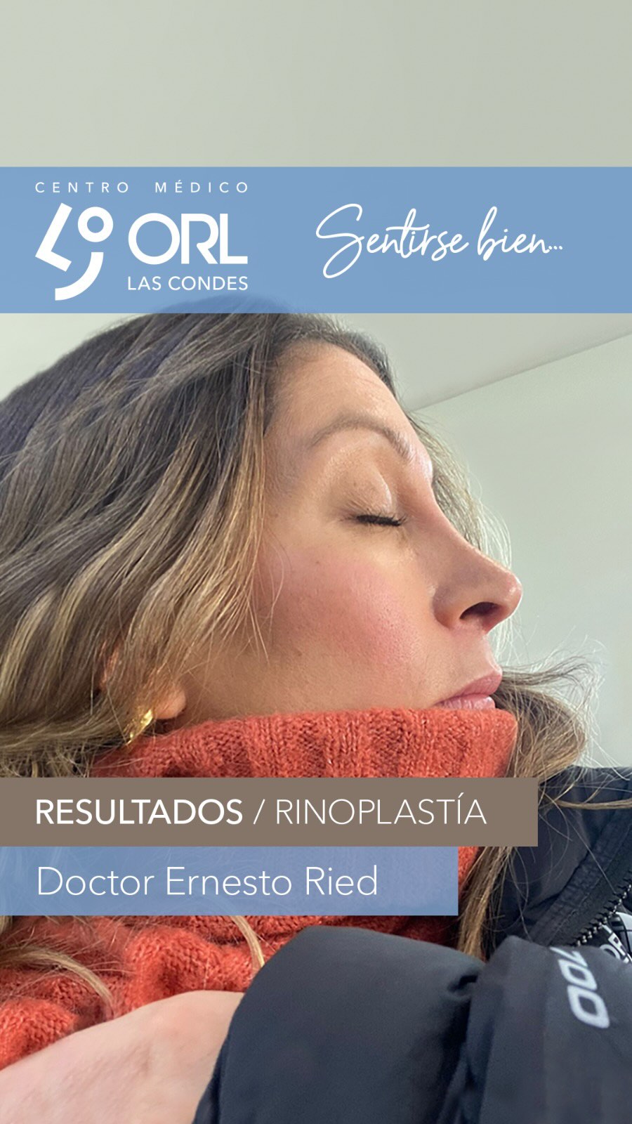 Queremos mostrarles el caso de esta querida paciente que operamos el 27 de Junio pasado. Ella es enfermera y ha sido muy entretenido para todo el equipo tenerla como paciente.
Gracias Valentina de parte de todos por compartirnos tus fotos. Y al igual que tu estamos felices con tu evolución en todo este proceso.
📌 Agenda hoy tu visita por telemedicina o presencial, para una evaluación de rinoplastia.
✅ Consultas al whats app +569 51731035
❇️ Centro Médico ORL las Condes en Estoril 200, Oficina 723, Las Condes, Santiago de Chile
📞 Reserva de horas:
Teléfono: +56 2 2480 1700
Whats app: +56 9 8846 5438
Mail: secretaria@orl-lascondes.cl
WEB: www.orl-lascondes.cl
⚠️• Los comentarios ofensivos o discriminatorios serán eliminados/bloqueados para proteger la integridad del paciente.
⚠️• Los resultados de cada paciente son únicos y dependen de sus antecedentes, tipo de piel, cirugía/técnica, cicatrización/recuperación y cuidados postoperatorios.
#rinoplastía #rinoseptoplastía #rinoplastíaultrasonica #rinoplastiaestetica #rhinoplasty #cirugiaestetica #rinoplastiasantiago #rinoplastíafuncional #reconstrucciónnasal #orl #otorrinolaringología #nariz #antesydespués