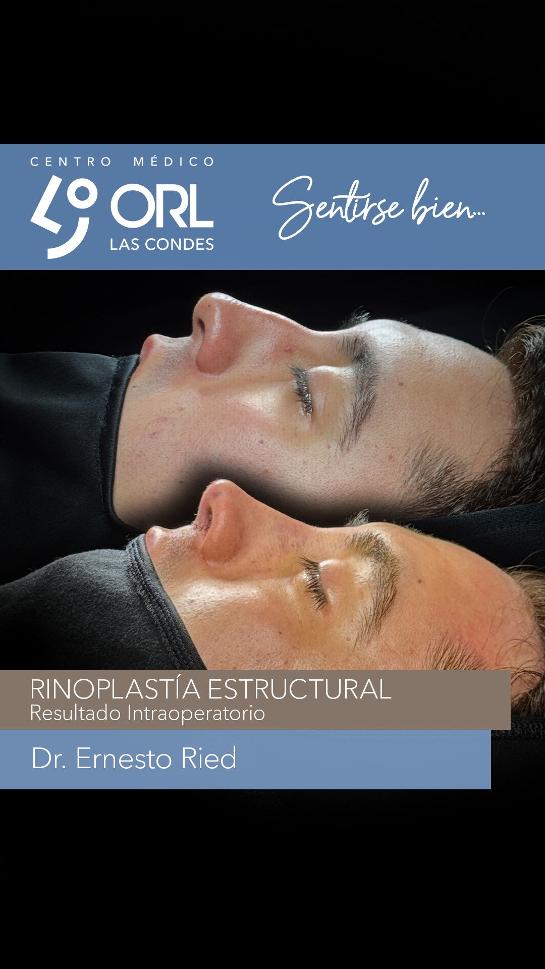Post quirúrgico inmediato de una rinoplastia estructural ultrasónica con un extensor vectorial 593 del @Dr.cristiancorderoc
✅ Desde Copiapó llegó este paciente que no le gustaba su nariz porque tenía una pequeña giba y la punta desviada. Había hecho correcciones con ácido hialurónico.
✅ El Dr. Ernesto Ried - @dr.ernestoried - realizó una cirugía estética y se corrigió la desviación y el dorso, es decir, se aprovechó de hacer una cirugía funcional sobre un deseo principalmente estético.
Que vuelvas a Sentirte bien es nuestro compromiso!
🗓️ Agenda hoy tu visita por telemedicina o presencial, para una evaluación.
Centro Médico ORL -Las Condes
Estoril 200, Oficina 723
Las Condes, Santiago de Chile
Reserva de horas:
Teléfono: +56 2 2480 1700
Whats app: +56 9 8846 5438
Mail: secretaria@orl-lascondes.cl
WEB: www.orl-lascondes.cl
⚠️Los comentarios ofensivos o discriminatorios serán eliminados/bloqueados para proteger la integridad del paciente.
⚠️Los resultados de cada paciente son únicos y dependen de sus antecedentes, tipo de piel, cirugía/técnica, cicatrización/recuperación y cuidados postoperatorios.
#rinoplastia #rinoseptoplastia #rinoplastiaultrasonica #rinoplastiafuncional #antesydespues