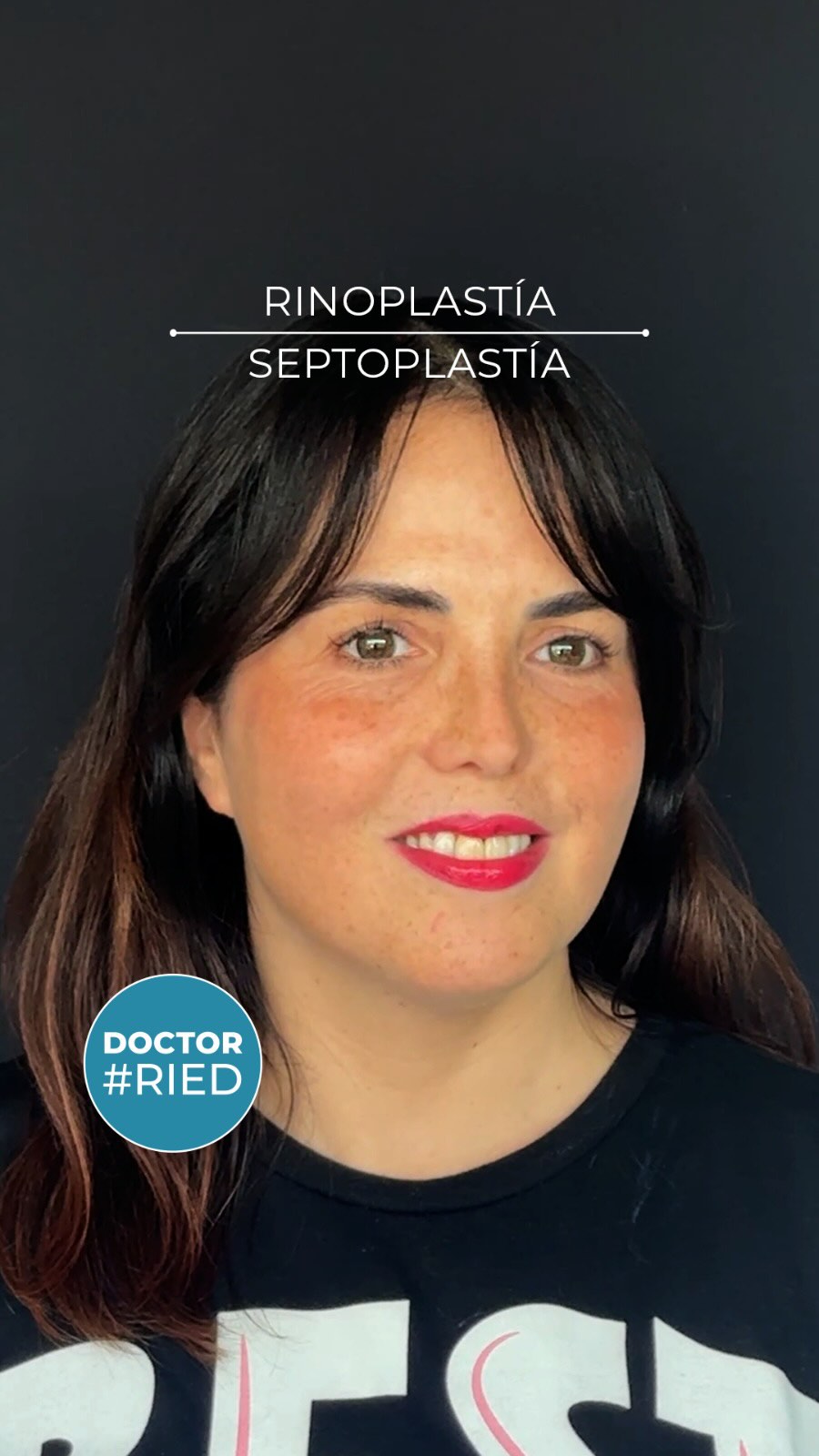 María José nos vino a ver porque tenía serios problemas para respirar, se le solicitaron exámenes que mostraron una alergia severa y una inflamación muy importante de los cornetes. Se le ofreció una cirugía para reducir el tamaño de estos y surgió la posibilidad de arreglar su nariz, se entusiasmó y ahora ella está feliz con el resultado a los 6 meses de operada así como nosotros también. Gracias María José por compartir tu resultado!!!! La rinoplastia es una cirugía compleja. Es muy importante que los cirujanos conozcamos las expectativas del paciente y le hagamos saber los riesgos y beneficios. La cirugía es individual de resultado único. No es posible garantizar los resultados. En ningún caso busca la perfección sino la funcionalidad de la nariz y la naturalidad del resultado. Quiero verte y escucharte. Agenda hoy tu visita por telemedicina o presencial, para una evaluación de rinoplastia. Clínica Las Condes y Centro Médico ORL las Condes en Estoril 200, Oficina 723, Las Condes, Santiago de Chile Reserva de horas: Centro Médico ORL Las Condes Teléfono: +56 2 2480 1700 Whats app: +56 9 8846 5438 Mail: secretaria@orl-lascondes.cl WEB: www.orl-lascondes.cl Clínica Las Condes Teléfono: +56 2 2610 8000, opción 1 • Los comentarios ofensivos o discriminatorios serán eliminados/bloqueados para proteger la integridad del paciente. #rinoplastía #rinoseptoplastía #rinoplastíaultrasonica #rinoplastíafuncional #antesydespues