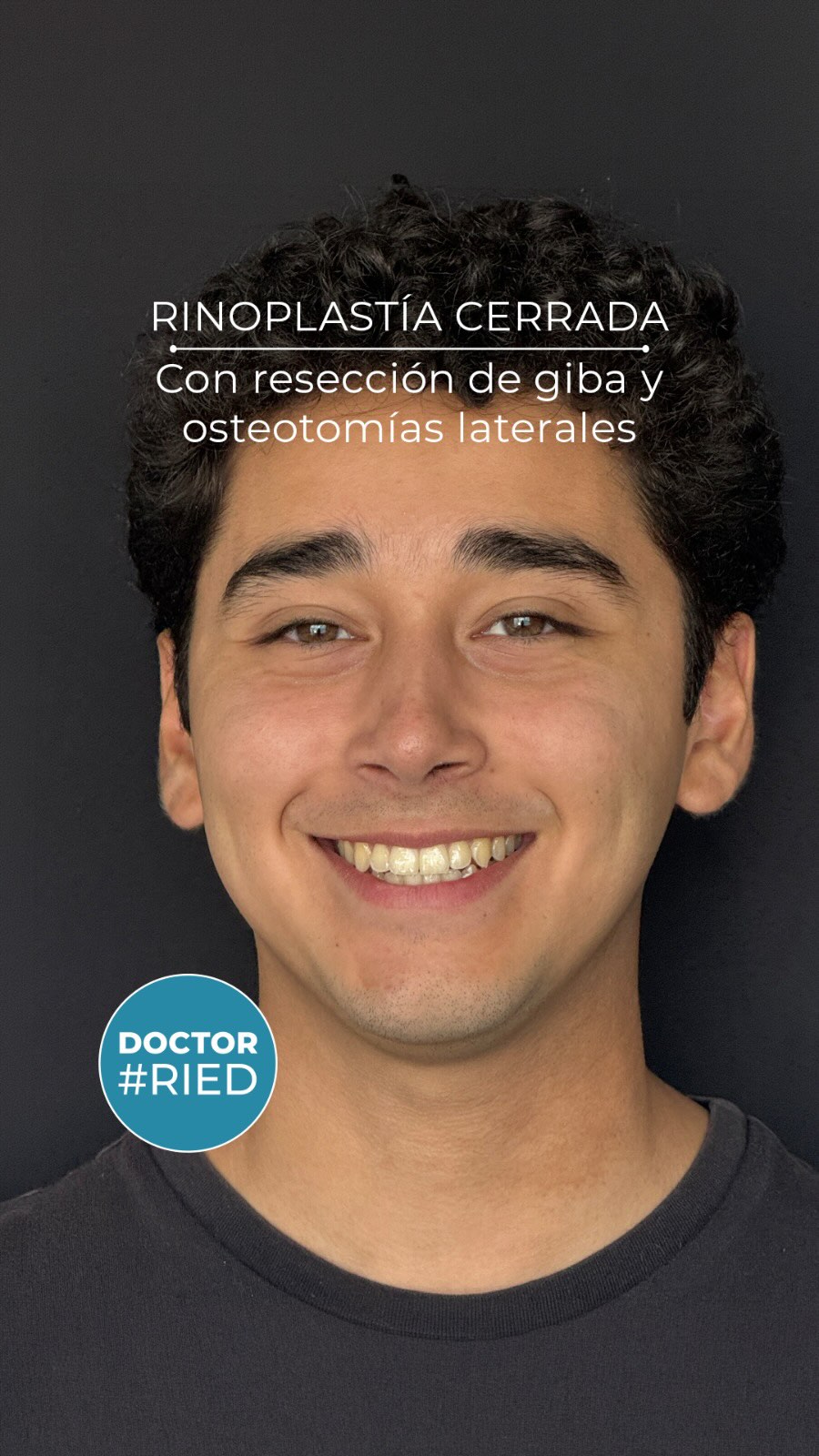 Este paciente vino a verme por un problema de obstrucción nasal por tabique desviado y grandes cornetes. Le gustaba su nariz, salvo el huesito prominente que tenía en el dorso. Se le propuso realizar una mejora cosmética y quedamos en usar una técnica cerrada con resección de la giba y osteotomías laterales para que se viera más fina sin cambiar la punta de la nariz que es lo que más le gustaba Compartimos el resultado a 10 semanas de la cirugía Cambios sutiles en la vista de frente y perfil que dejaron al paciente y al equipo muy contentos. Cada paciente busca algo distinto. Quiero verte y escucharte! ✅ Agenda hoy tu visita por telemedicina o presencial, para una evaluación de rinoplastia. Consultas al whats app +569 51731035 Clínica Las Condes y Centro Médico ORL las Condes en Estoril 200, Oficina 723, Las Condes, Santiago de Chile 📅 Reserva de horas: Centro Médico ORL Las Condes Teléfono: +56 2 2480 1700 Whats app: +56 9 8846 5438 Mail: secretaria@orl-lascondes.cl WEB: www.orl-lascondes.cl Clínica Las Condes Teléfono: +56 2 2610 8000, opción 1 ⚠️ Los comentarios ofensivos o discriminatorios serán eliminados/bloqueados para proteger la integridad del paciente. ⚠️ Los resultados de cada paciente son únicos y dependen de sus antecedentes, tipo de piel, cirugía/técnica, cicatrización/recuperación y cuidados postoperatorios. #rinoplastía #rinoseptoplastía #rinoplastíaultrasonica #rinoplastíafuncional #antesydespues