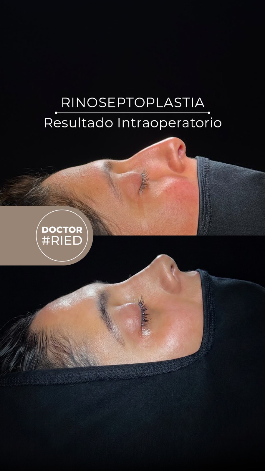 ✨ Esta paciente buscaba un cambio en su vida, y parte de ese cambio fue mejorar el aspecto de su nariz. 👃 Le realizamos un pequeño rebaje del dorso nasal, con una resección de la giba de 1.7 mm, elevamos ligeramente la punta y hicimos una plicatura de los domos para darle mayor armonía. 💨 Al mismo tiempo, corregimos la desviación del tabique nasal y cauterizamos los cornetes para mejorar su respiración. 🌿 El resultado: un cambio sutil, elegante y natural que le aporta un aire más fresco y renovado. 📸 En las fotos se muestra el resultado inmediato post operatorio, comparando el antes y el después. 📅 Agenda hoy tu visita por telemedicina o presencial para una evaluación de rinoplastia. 📲 Consultas por WhatsApp: +569 5173 1035 🏥 Ven a verme a: • Clínica Las Condes • Centro Médico ORL Las Condes Estoril 200, Oficina 723, Las Condes, Santiago de Chile 📞 Reserva de horas: Centro Médico ORL Las Condes Tel: +56 2 2480 1700 WhatsApp: +56 9 8846 5438 Email: secretaria@orl-lascondes.cl Web: www.orl-lascondes.cl Clínica Las Condes Tel: +56 2 2610 8000, opción 1 ⚠️ Los comentarios ofensivos o discriminatorios serán eliminados/bloqueados para proteger la integridad del paciente. #rinoplastía #rinoseptoplastía #rinoplastíaultrasonica #rinoplastiaestetica #rhinoplasty