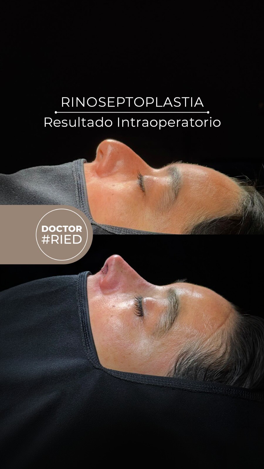 ¡Cambio inmediato en pabellón! 🔥👃 ¡Muchísimas gracias a nuestra paciente por permitirnos mostrar sus fotos! 🙌✨ Lo que ven aquí es un registro intraoperatorio inmediato. Es decir, el resultado real en la mesa de cirugía justo antes de poner la férula. En esta cirugía no solo buscamos dejar una nariz estética, estilizada y en armonía con el rostro, sino también corregir la función interna para que el paciente pueda respirar al 100%. Podríamos decir que es el combo perfecto: ¡salud y estética en un solo procedimiento! 🚀 ⚠️ Dato clave: Recuerda que este es un resultado inmediato. El definitivo se asoma pasados unos meses, cuando la inflamación baje por completo. Si tú también estás pensando en dar el paso y quieres cambiar tu vida, ¡agenda hoy mismo tu evaluación! Puede ser por telemedicina o presencial. 📲👇 🗓️ ¿DÓNDE AGENDAR TU HORA? 💬 Consultas rápidas directas al WhatsApp: +569 51731035 Reserva de horas: 1️⃣ Centro Médico ORL Las Condes • 📞 Teléfono: +56 2 2480 1700 • 🟢 WhatsApp: +56 9 8846 5438 • 📧 Mail: secretaria@orl-lascondes.cl • 🌐 WEB: www.orl-lascondes.cl 2️⃣ Clínica Las Condes • 📞 Teléfono: +56 2 2610 8000, opción 1 🛑 Nota: Los comentarios ofensivos o discriminatorios serán eliminados/bloqueados para proteger la integridad y privacidad de nuestro paciente. #rinoplastía #rinoseptoplastía #rinoplastíaultrasonicachile #rhinoplasty #drried