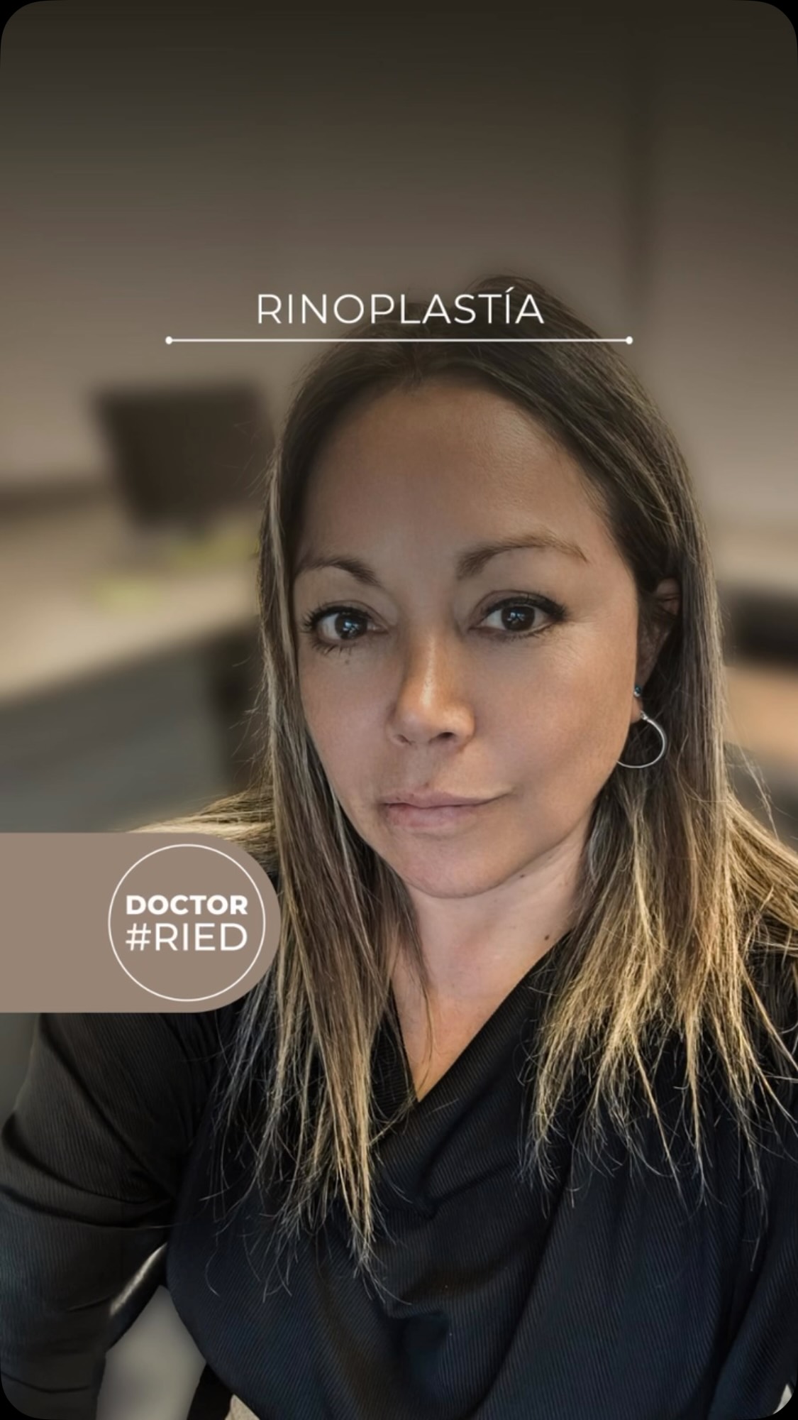 💞 ¡Patricia, nuestra guerrera de la sonrisa! 💞 Estamos profundamente agradecidos con Patricia, una paciente entrañable. Su historia nos recuerda el verdadero propósito de la medicina: sanar y cuidar. Patricia vino buscando una rinoplastia estética, pero el camino dio un giro inesperado cuando detectamos un tumor maligno. Fue un proceso de recuperación mucho más largo de lo imaginado, pero ella nunca perdió la esperanza. Y hoy, ¡el triunfo es suyo! Al verla sonreír de esa manera tan linda y feliz, nuestro corazón se llena de alegría. ¡Estás espectacular, Patricia! 😍 Gracias, querida Patricia, por elegirnos en este viaje tan importante. Tu fortaleza es una inspiración para todos. ¿Qué mensaje le dejarías a Patricia para celebrar su recuperación? ¡Cuéntanos en los comentarios! 👇💖 #DrRied #Testimonio #Fortaleza #Rinoplastia #deteccióntemprana