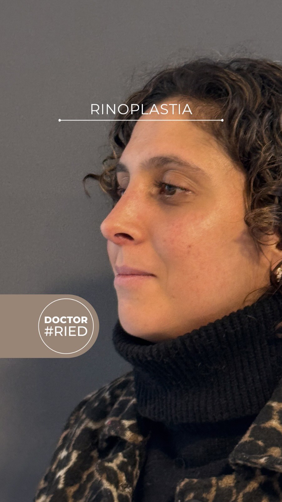 Rinoseptoplastia: Estética y salud respiratoria. 👇 Te compartimos el análisis en todos los ángulos de esta querida paciente. En una rinoseptoplastia trabajamos de manera integral: 🔹 Vista de frente y oblicua: Logramos mayor simetría y definición en la punta nasal. 🔹 Vista de perfil: Suavizamos el dorso para un contorno fluido y natural. 🔹 Parte funcional: Corregimos desviaciones internas para mejorar el paso del aire. El resultado es una nariz que encaja perfectamente con las facciones de la paciente y mejora su calidad de vida. Gracias por permitirnos mostrar tu caso ¡!!!! 💬 Consultas rápidas directas al WhatsApp: +569 51731035 Reserva de horas: 1️⃣ Centro Médico ORL Las Condes • 📞 Teléfono: +56 2 2480 1700 • 🟢 WhatsApp: +56 9 8846 5438 • 📧 Mail: secretaria@orl-lascondes.cl • 🌐 WEB: www.orl-lascondes.cl 2️⃣ Clínica Las Condes • 📞 Teléfono: +56 2 2610 8000, opción 1 🛑 Nota: Los comentarios ofensivos o discriminatorios serán eliminados/bloqueados para proteger la integridad y privacidad de nuestro paciente.