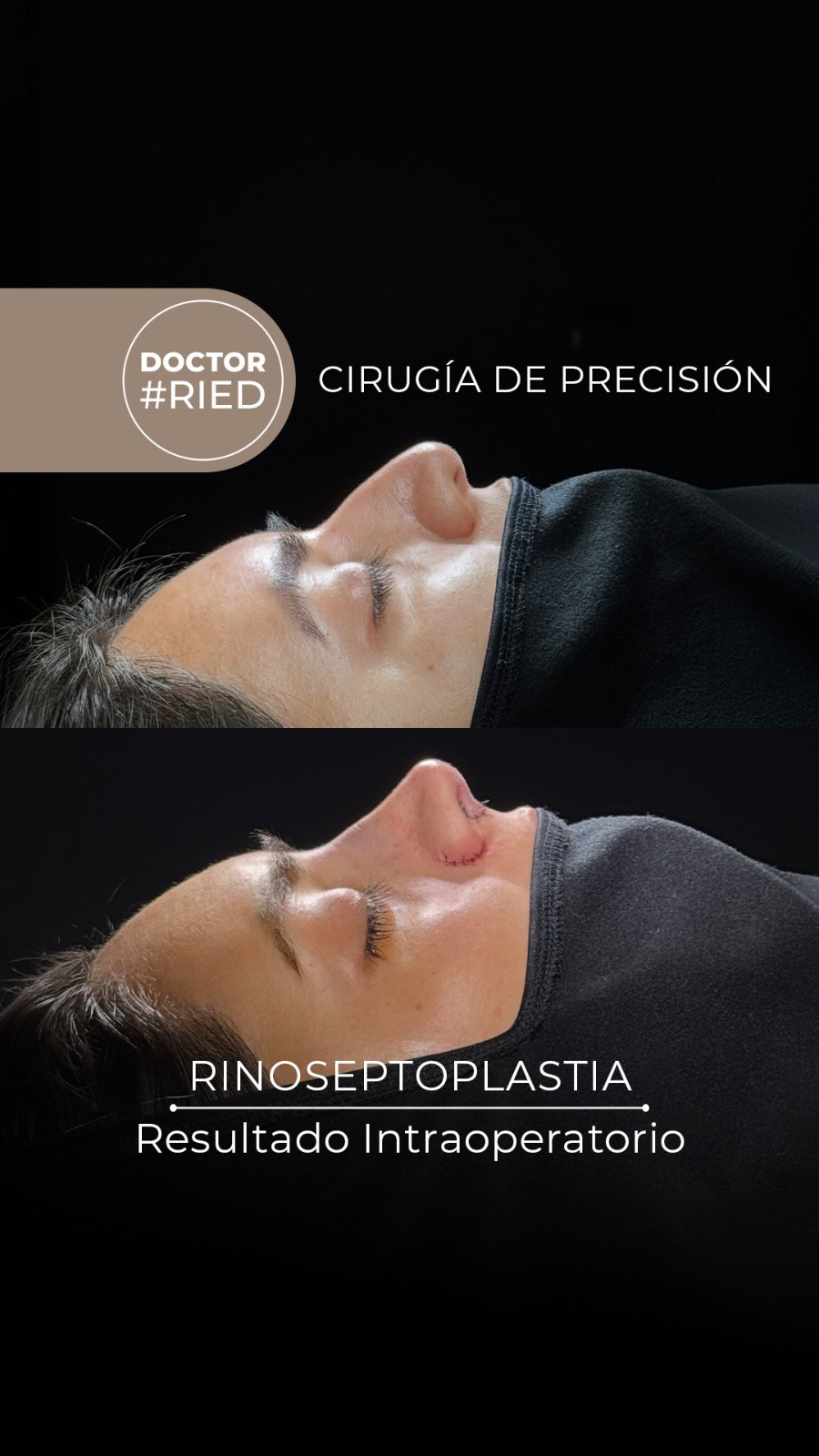 “Cirugía de Precisión: La conjunción entre microcirugía de alta complejidad, planificación y expectativas reales.” El recorrido de este cambio: 1️⃣ Análisis y simulación en consulta: Evaluamos la estructura facial de la paciente y planificamos digitalmente los objetivos a alcanzar. Nos aseguramos de alinear sus expectativas con lo que técnicamente es seguro y estético: que respire bien y que se vea bien. 2️⃣ Medición milimétrica en quirófano: Durante la cirugía, utilizamos el perfilómetro para garantizar que los ángulos y proporciones planificados en la simulación se repliquen con máxima exactitud. 3️⃣ Resultado final: Una nariz funcional, armónica y como la planificamos con la paciente. La clave de una rinoplastia exitosa está en cuidar cada milímetro del proceso, desde la primera consulta hasta el último punto. 📌 Nota médica: La rinoplastia es una cirugía compleja y cada procedimiento es individual y único. Es fundamental conocer las expectativas de cada paciente, así como transparentar los riesgos y beneficios. El resultado final depende también de la anatomía, la cicatrización, la recuperación y los cuidados postoperatorios de cada persona. 💬 ¿Tienes dudas sobre cómo planificamos una rinoplastia? Déjamela en los comentarios o envíame un mensaje directo. 🛡️ Espacio seguro: Los comentarios ofensivos o discriminatorios serán eliminados para proteger la integridad y privacidad de nuestros y nuestras pacientes. #Rinoplastia #DrRied #CirugiaDePrecision #Microcirugia #AntesYDespues RinoplastiaChile CirugiaFacial EsteticaFacial