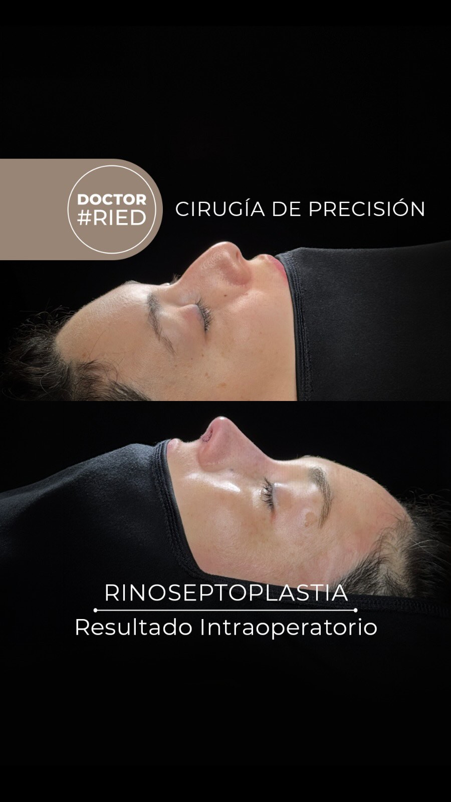 “Detrás de cada una de mis cirugías de nariz y oído hay una planificación milimétrica y microcirugía de alta precisión, cuidando todo el camino desde la primera consulta hasta el último punto.” El recorrido de este cambio: 1️⃣ Análisis y simulación en consulta: Evaluamos la estructura facial de la paciente y planificamos digitalmente los objetivos a alcanzar. Nos aseguramos de alinear sus expectativas con lo que técnicamente es seguro: que respire bien y que ella se vea bien. 2️⃣ Medición milimétrica en quirófano: Durante la cirugía, utilizamos el perfilómetro para garantizar que los ángulos y proporciones planificados en la simulación se repliquen con máxima exactitud. 📐✨ 3️⃣ Resultado final: Una nariz funcional, armónica y, sobre todo, como la planificamos con la paciente. 📌 Nota médica: La rinoplastia es una cirugía compleja y cada procedimiento es individual y único. Es fundamental conocer las expectativas de cada paciente, así como transparentar los riesgos y beneficios. El resultado final depende también de la anatomía, la cicatrización, la recuperación y los cuidados postoperatorios de cada persona. 💬 Reserva una hora por Whats app al 951731035 o en Clínica Las Condes al +56 2 2610 8000, opción 1 🛡️ Espacio seguro: Los comentarios ofensivos o discriminatorios serán eliminados para proteger la integridad y privacidad de nuestros pacientes. #Rinoplastia #DrRied #CirugiaDePrecision #Microcirugia #AntesYDespues